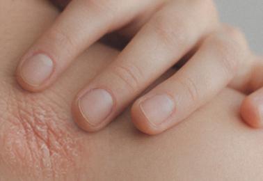 Comment reconnaître un eczéma ?